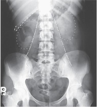 Which structures are outlined with dots in this AP image of the abdomen?   A)  Stomach B)  Liver C)  Kidneys D)  Psoas muscles