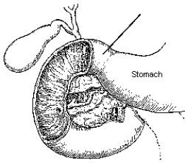The area identified in the figure below is the:   A)  fundus. B)  duodenum. C)  pyloric portion. D)  angular notch.