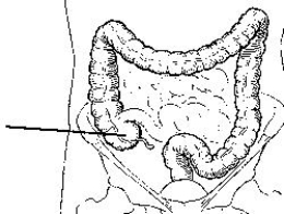 The area of the colon identified in the figure below is the:   A)  cecum. B)  ileum. C)  sigmoid. D)  rectum.