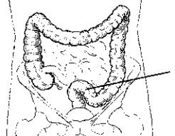 The area of the colon identified in the figure below is the:   A)  cecum. B)  ileum. C)  rectum. D)  sigmoid.