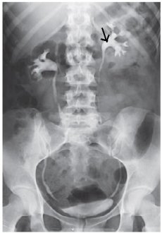The dilated, proximal portion of the ureter is labeled with an arrow. What is the name of this anatomy shown in the image from an IVU below?   A)  Renal pelvis B)  Hilum C)  Calyx D)  Trigone