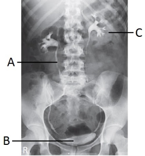 Letter B shown in the image from an IVU examination below labels the:   A)  right renal pelvis. B)  right ureter. C)  urinary bladder. D)  symphysis pubis.