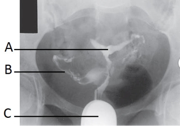 <strong>Letter A in the image below labels the: </strong> A) uterus. B) contrast spill from open uterine tube. C) speculum. D) vagina.
