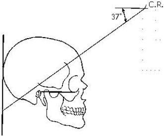 Which method of examining the skull is identified in the figure below?   A)  Haas B)  Towne C)  Shüller D)  Caldwell