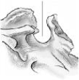 The part of the sphenoid bone identified in the figure below is the:   A)  clivus. B)  foramen magnum. C)  sella turcica. D)  dorsum sellae.