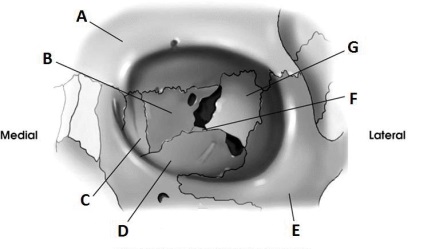 What bone is labeled as letter A in the diagram below of the orbit?   A)  Frontal B)  Zygoma C)  Maxilla D)  Sphenoid