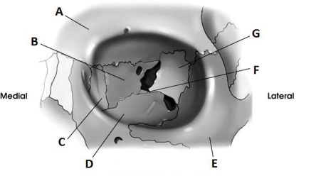 Letter E in the diagram below of the orbit labels the:   A)  sphenoid. B)  zygoma. C)  maxilla. D)  frontal.