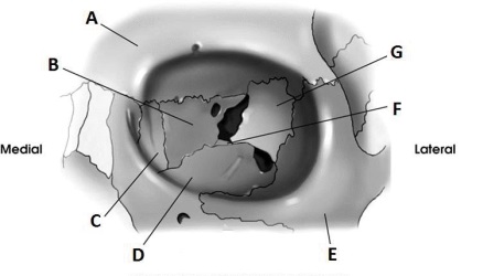 Letter B in the diagram below of the orbit labels the:   A)  ethmoid. B)  sphenoid. C)  lacrimal. D)  maxilla.