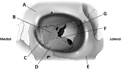 Letter G in the diagram below of the orbit labels the:   A)  ethmoid. B)  sphenoid. C)  lacrimal. D)  maxilla.