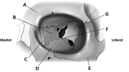 Letter F in the diagram below of the orbit labels the:   A)  ethmoid. B)  sphenoid. C)  lacrimal. D)  palatine.