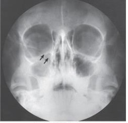 What is the projection (method)  demonstrated in the image below used to evaluate trauma to the orbit?   A)  Parietoacanthial (Waters)  B)  PA axial (Caldwell)  C)  AP axial (Towne)  D)  PA axial (Haas) 