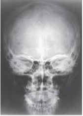 What is the projection (method)  demonstrated in the image below used to evaluate the cranium?   A)  Parietoacanthial (Waters)  B)  PA axial (Caldwell)  C)  AP axial (Towne)  D)  PA