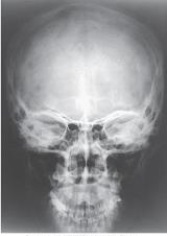 How was the central ray directed to obtain the image below used to evaluate the cranium?   A)  Perpendicular B)  15 degrees caudad C)  15 degrees cephalad D)  37 degrees caudad