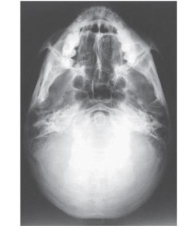 How was the central ray directed to obtain the image below used to evaluate the cranium?   A)  Perpendicular to IOML B)  15 degrees caudad C)  25 degrees cephalad D)  37 degrees caudad