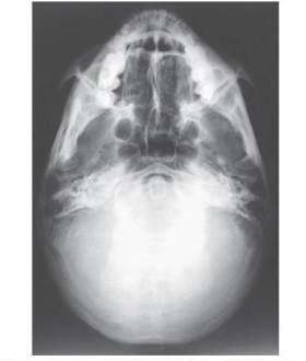 What projection (method)  is demonstrated in the image below used to evaluate the cranium?   A)  PA axial (Caldwell)  B)  AP axial (Towne)  C)  PA axial (Haas)  D)  SMV (Shüller) 