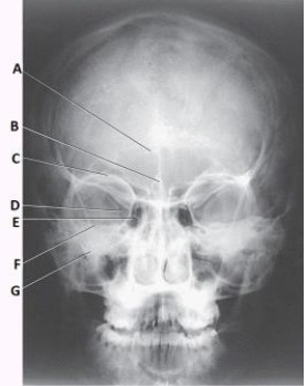 What projection (method)  is demonstrated in the image below used to evaluate the cranium?   A)  PA axial (Caldwell)  B)  AP axial (Towne)  C)  PA axial (Haas)  D)  SMV (Shüller) 