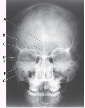 Letter F in the image below used to evaluate the cranium labels the:   A)  ethmoid sinuses. B)  crista galli. C)  petrous ridge. D)  inferior orbital margin.
