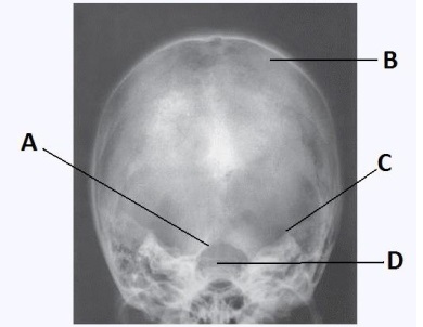 What projection (method)  is demonstrated in the image below used to evaluate the cranium?   A)  PA B)  AP axial (Towne)  C)  PA axial (Caldwell)  D)  SMV (Schüller) 