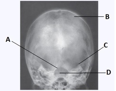 Letter A in the image below used to evaluate the cranium labels the:   A)  dorsum sella. B)  foramen magnum. C)  petrous ridge. D)  parietal bone.