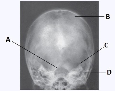Letter B in the image below used to evaluate the cranium labels the:   A)  dorsum sella. B)  foramen magnum. C)  petrous ridge. D)  parietal bone.