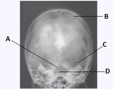 Letter C in the image below used to evaluate the cranium labels the:   A)  dorsum sella. B)  foramen magnum. C)  petrous ridge. D)  parietal bone.