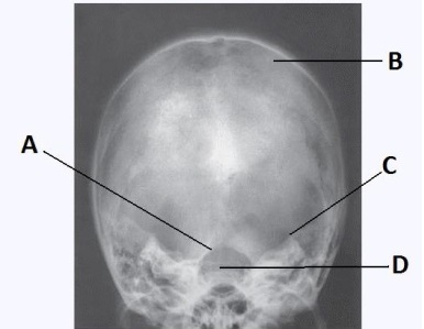 Letter D in the image below used to evaluate the cranium labels the:   A)  dorsum sella. B)  foramen magnum. C)  petrous ridge. D)  parietal bone.