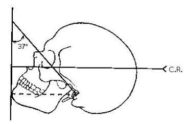 The figure below demonstrates the _____ method.   A)  Haas B)  Stenvers C)  Waters D)  reverse Waters
