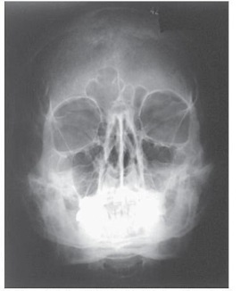 What projection (method)  of the facial bones is demonstrated in the image below?   A)  AP axial (Towne)  B)  Parietoacanthial (Waters)  C)  Parietoacanthial (modified Waters)  D)  PA axial (Caldwell) 