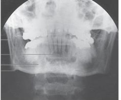What projection and anatomy is demonstrated in the image below?   A)  AP axial of the TMJs B)  PA axial of the mandibular rami C)  PA of the mandibular body D)  Axiolateral oblique of the mandibular body