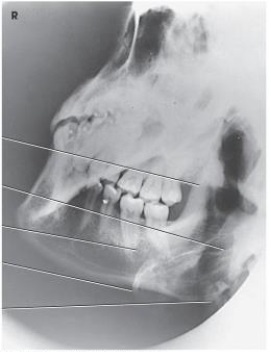 What projection and anatomy is demonstrated in the image below?   A)  AP axial of the TMJs B)  PA axial of the mandibular rami C)  PA of the mandibular body D)  Axiolateral oblique of the mandibular body