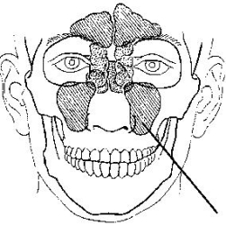 The sinus identified in the figure below is the:   A)  frontal. B)  maxillary. C)  ethmoidal. D)  sphenoidal.