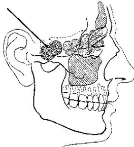 The sinus identified in the figure below is the:   A)  frontal. B)  maxillary. C)  ethmoidal. D)  sphenoidal.