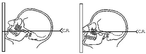 Which drawing in the figure below demonstrates the correct head position for the Waters method?   A)  Left B)  Right