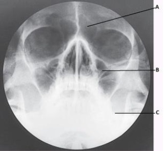 The letter C in the image below of the paranasal sinuses labels the:   A)  sphenoid sinuses. B)  condyle of the mandible. C)  petrous ridge. D)  vomer.