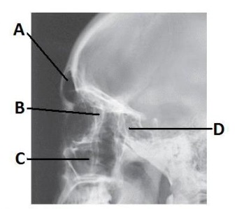 The letter C in the image below of the paranasal sinuses labels the:   A)  sphenoid sinuses. B)  maxillary sinuses. C)  petrous ridge. D)  ethmoid sinuses.