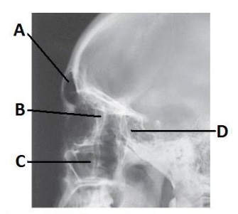 The letter A in the image below of the paranasal sinuses labels the:   A)  frontal sinuses. B)  ethmoid sinuses. C)  sphenoid sinuses. D)  crista galli.