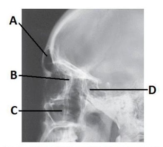 The letter D in the image below of the paranasal sinuses labels the _____ sinuses.   A)  frontal B)  ethmoid C)  sphenoid D)  maxillary