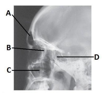 The letter B in the image below of the paranasal sinuses labels the _____ sinuses.   A)  frontal B)  ethmoid C)  sphenoid D)  maxillary