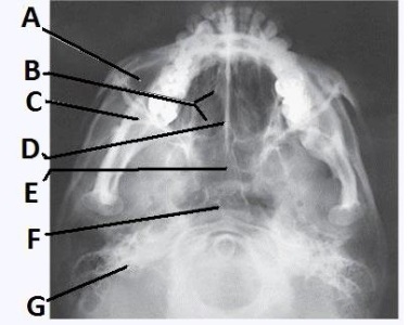 The letter D in the image below of the paranasal sinuses labels the:   A)  crista galli. B)  vomer. C)  perpendicular plate of the ethmoid bone. D)  cribriform plate.
