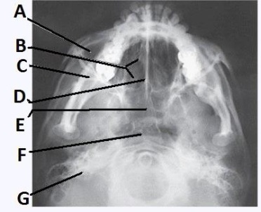 The letter E in the image below of the paranasal sinuses labels the _____ sinuses.   A)  ethmoid B)  sphenoid C)  maxillary D)  frontal