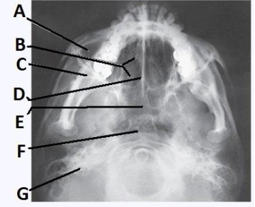 The letter F in the image below of the paranasal sinuses labels the:   A)  ethmoid sinuses. B)  sphenoid sinuses. C)  maxillary sinuses. D)  pharynx.