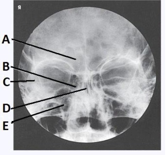 The letter B in the image below of the paranasal sinuses labels the _____ sinuses.   A)  ethmoid B)  sphenoid C)  maxillary D)  frontal