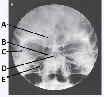 The letter C in the image below of the paranasal sinuses labels the:   A)  ethmoid sinuses. B)  sphenoid sinuses. C)  maxillary sinuses. D)  petrous ridge.