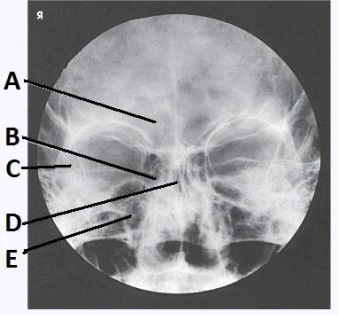 The letter D in the image below of the paranasal sinuses labels the _____ sinuses.   A)  ethmoid B)  sphenoid C)  maxillary D)  frontal