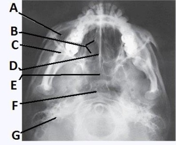 The letter G in the image below of the paranasal sinuses labels the:   A)  ethmoid sinuses. B)  sphenoid sinuses. C)  maxillary sinuses. D)  petrosa.