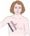 The projection of the breast shown in the figure below is a:   A)  mediolateral (ML) . B)  lateromedial (LM) . C)  mediolateral oblique (MLO) . D)  lateromedial oblique (LMO) .
