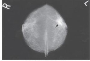 Examine the images below. Which mammographic projections are demonstrated?   A)  Craniocaudal B)  Caudocranial C)  Mediolateral oblique D)  Lateromedial