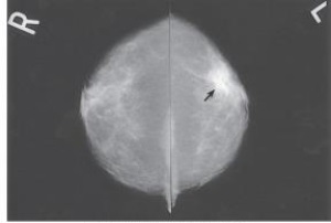 The arrow in the images below points to a mass with the characteristics of a:   A)  benign tumor. B)  malignant tumor. C)  fibrous tissue mass. D)  cystic lesion.