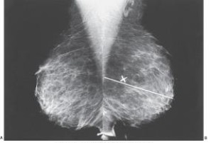 What projection is demonstrated in the images below?   A)  Craniocaudal B)  Exaggerated craniocaudal C)  Mediolateral oblique D)  Lateromedial