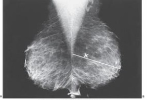 The white line, labeled as X in the images below is the _____ line.   A)  posterior nipple B)  pectoralis muscle C)  breast width D)  breast length